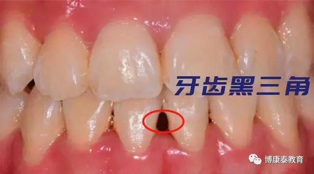 博康泰|三招消除牙齿的黑三角