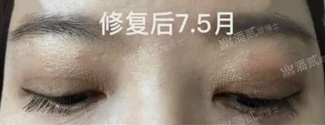 双眼皮失败眼角处有褶皱,双眼皮失败后闭眼痕迹