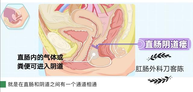 直肠阴道瘘是怎么回事？分哪几类？