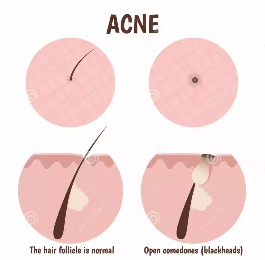 脸上毛孔粗大黑头粉刺多怎么改善,脸上都是黑头粉刺毛孔粗大怎么弄