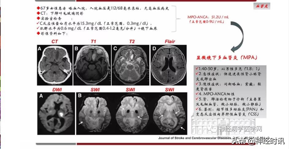 缺血性脑血管病出血评估,脑血管微出血怎么治疗