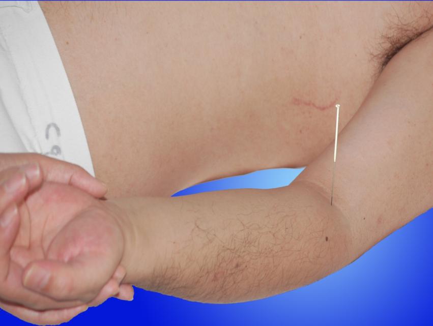 分期针刺治疗脑卒中后肢体功能障碍