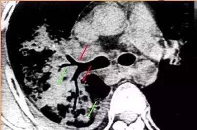 肺部ct十大征象,肺部ct正常图和异常图的区别