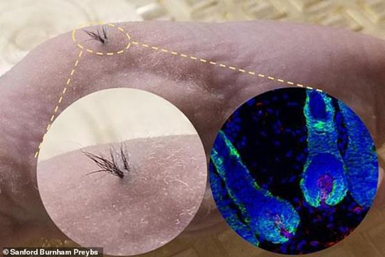 国外治疗秃顶最好的方法,30岁地中海秃顶有救吗