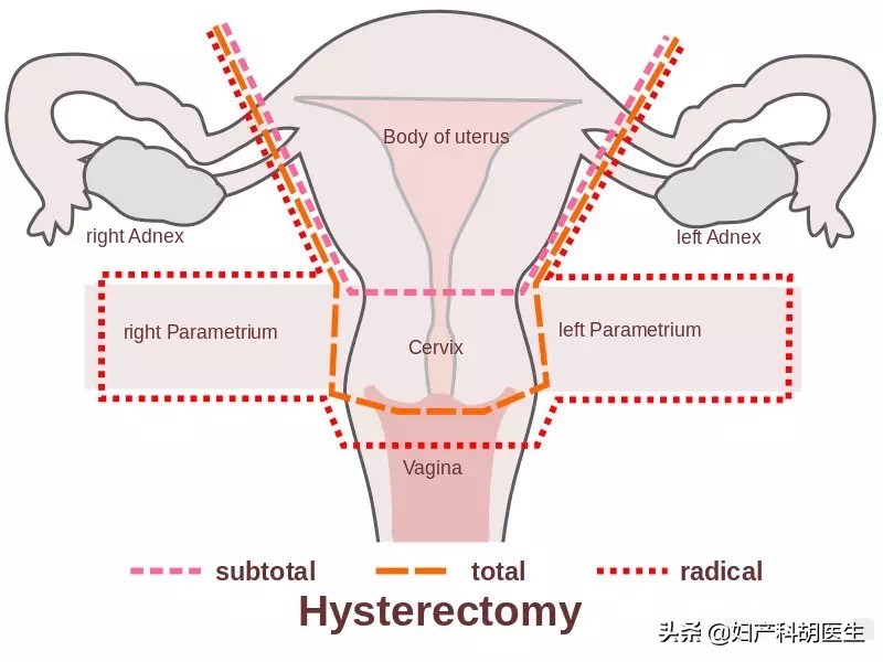 辟谣:切除子宫对女人会有哪些影响?