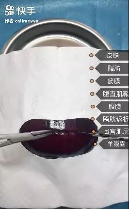 香蕉割包皮，洋葱剖腹产？这是我见过最秀的医生