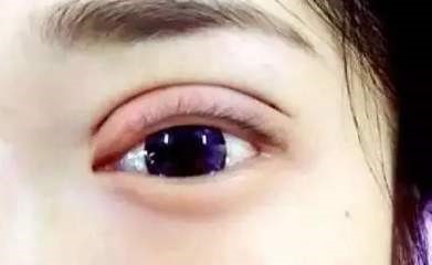 同样做双眼皮为什么价格差那么多,眼袋和双眼皮同时做眼会变小吗