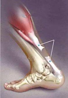 易建联跟腱受伤全过程,易建联注意保护跟腱