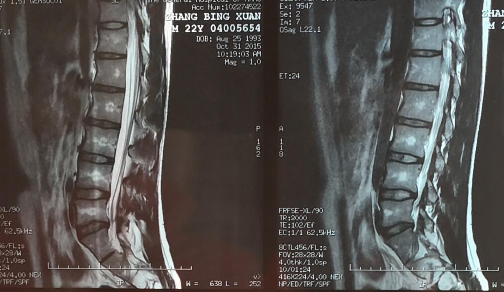 腰突案例：他这样子锻炼半年，腰不痛腿不麻，日走万步都没事了