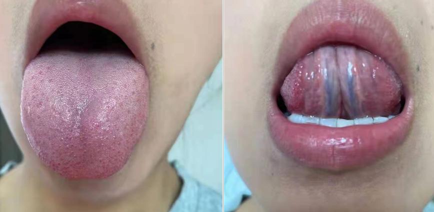 补中益气治疗脱肛,脱肛服用补中益气汤一般服多久