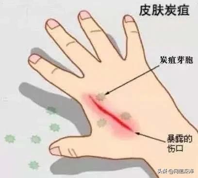 炭疽病的介绍,最常见的炭疽类型是啥