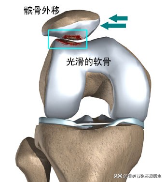 髌骨痛不能弯曲怎么办,髌骨不疼但脱位了怎么治