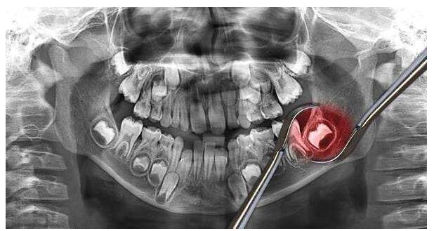 智齿冠周炎剧痛怎么缓解疼痛,智齿冠周炎急性怎么缓解疼痛