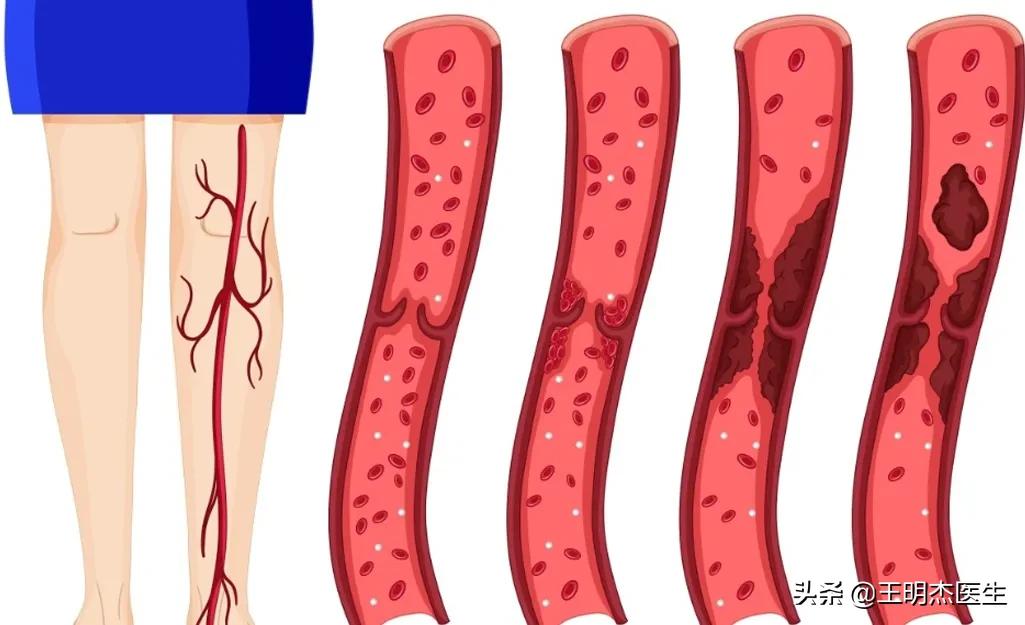 深静脉血栓几年能治好吗,静脉血栓住院治疗需多久可以治好