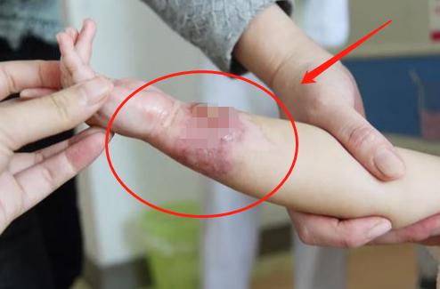 孩子严重烫伤9天才被家长送医,儿童烫伤最佳处理时间只有两分钟