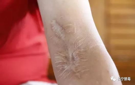 静脉注射补气血效果,静脉注射恢复血管弹性