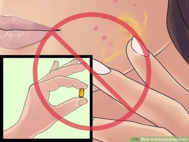 长完痘的红色痘坑怎么弄,怎么预防痘坑形成