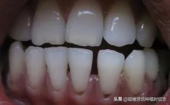 牙龈萎缩露出牙根怎么刷牙,牙龈萎缩的厉害露出牙根怎么补救