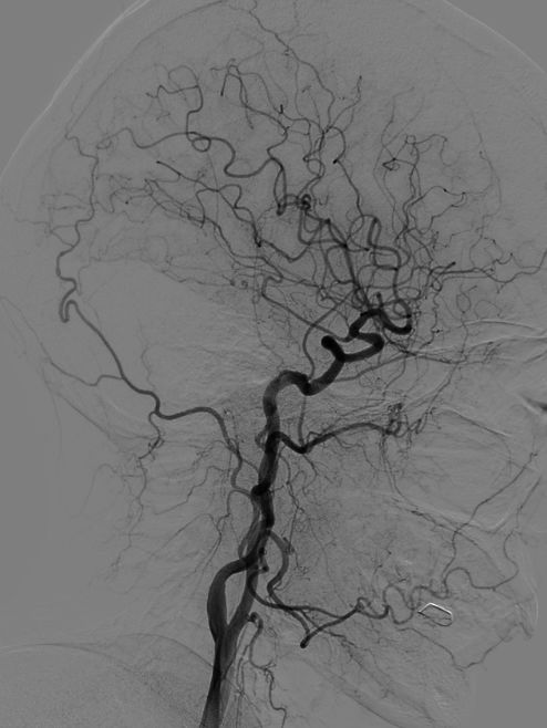Tubridge®治疗多发性动脉瘤