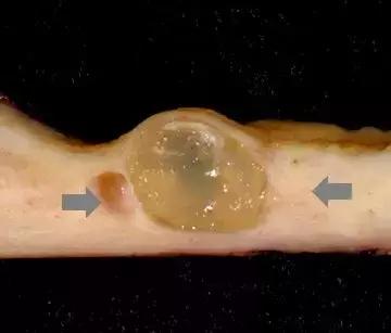 宫颈糜烂二度宫颈肥大宫颈囊肿,宫颈糜烂肥大囊肿会引起宫颈癌吗