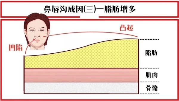 关于法令纹的冷知识,关于法令纹的误解你中招了吗
