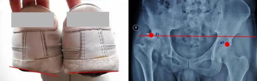 双脚外侧鞋底磨损严重,双脚鞋底磨损程度不同