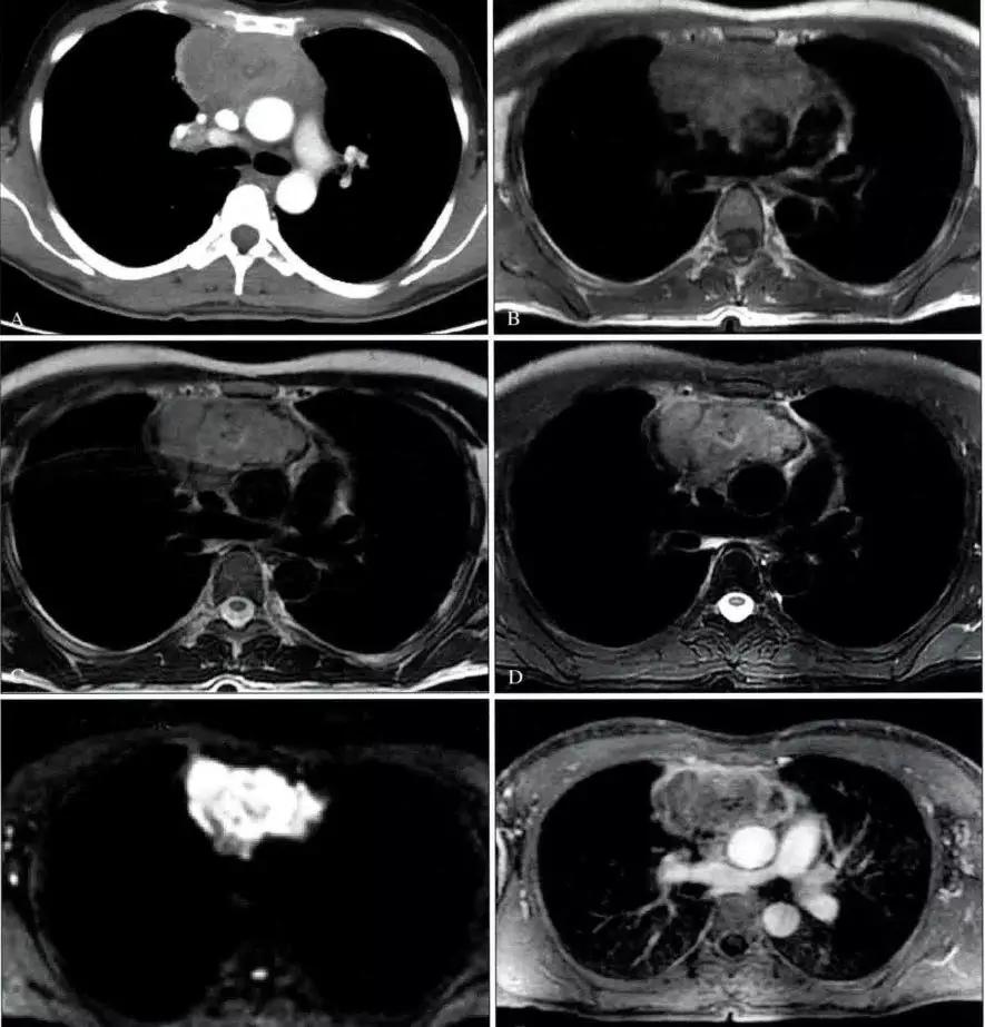 胸腺增生和纵隔肿瘤的区别和症状,纵隔胸腺肿瘤的常见临床症状表现