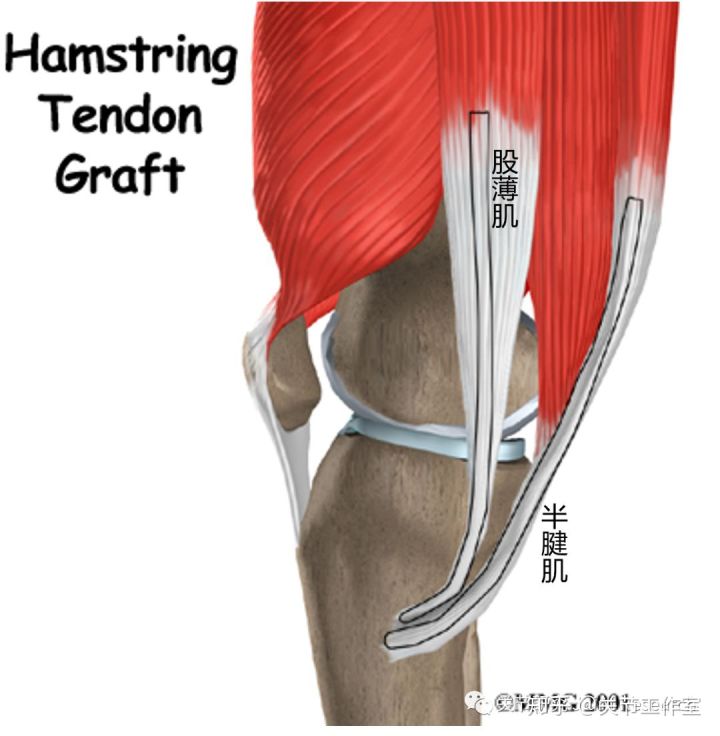前交叉韧带断裂为什么没评上伤残,前交叉韧带断裂有什么症状