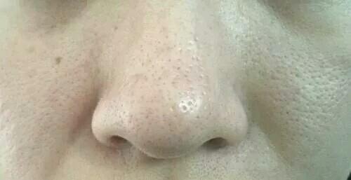 28岁毛孔粗大怎么办,28岁毛孔变粗大是什么原因