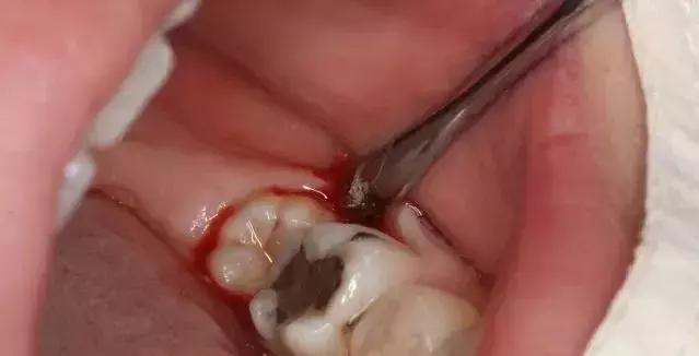 拔牙打麻药大脑是清醒的吗,拔牙打麻药会不会影响恒牙