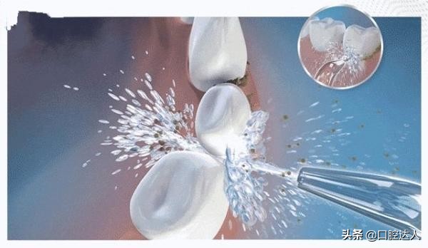 有蛀牙能去洗牙吗,有蛀牙还可以洗牙吗