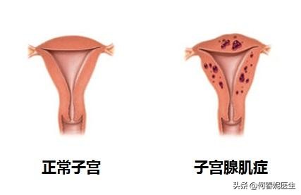 曼月乐能治疗妇科炎症吗,曼月乐有避孕效果吗