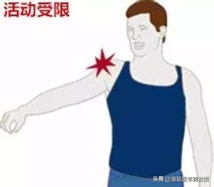 黄教授讲脑梗,中风后遗症肩痛的康复治疗