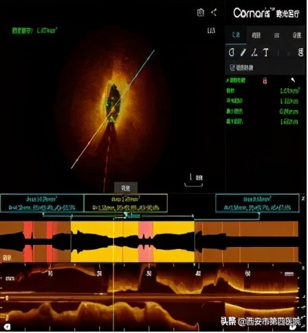 我院完成首例冠脉介入治疗,你是我的眼睛医院