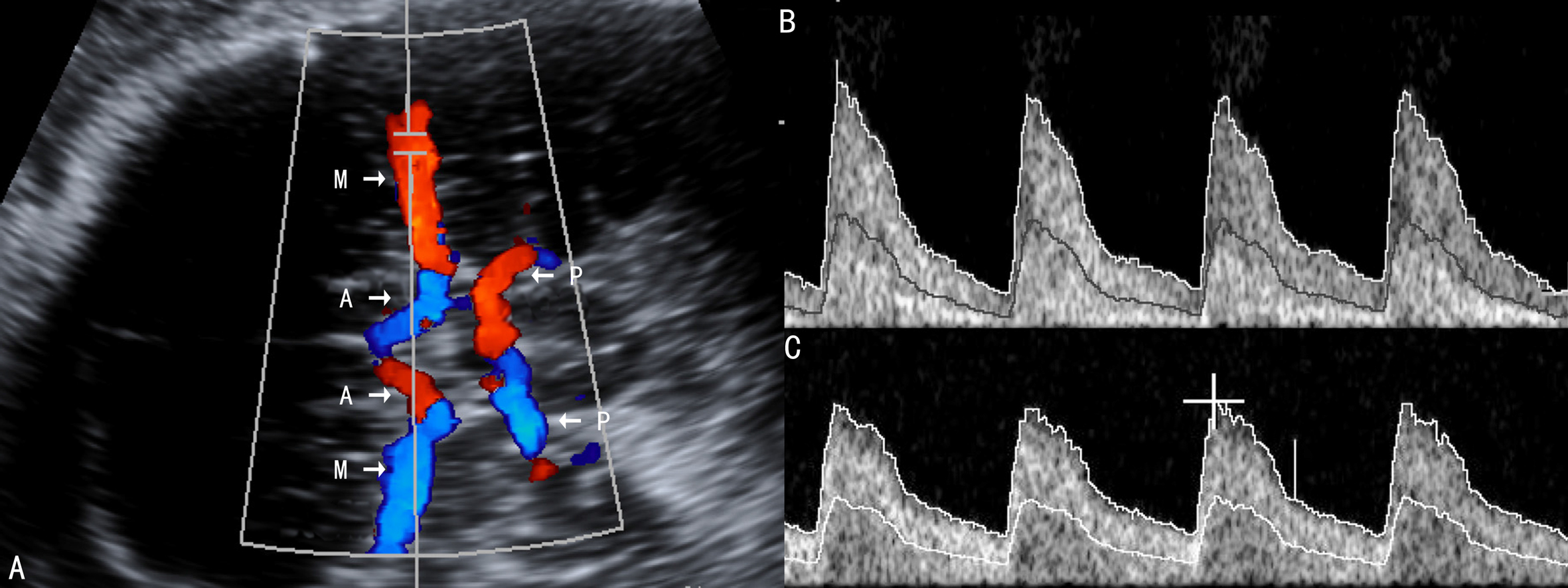 胎儿2级彩色多普勒超声图片,彩色多普勒胎儿超声诊断报告单