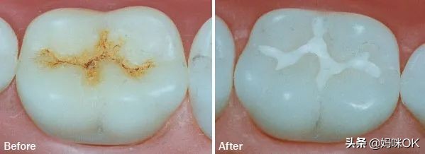 每个饱受“蛀牙”折磨的妈妈都走上了这条路……