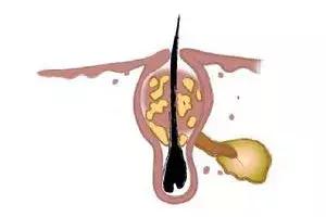 9岁女孩鼻子上长黑头怎么去除,小女孩鼻子上的黑头怎么去除