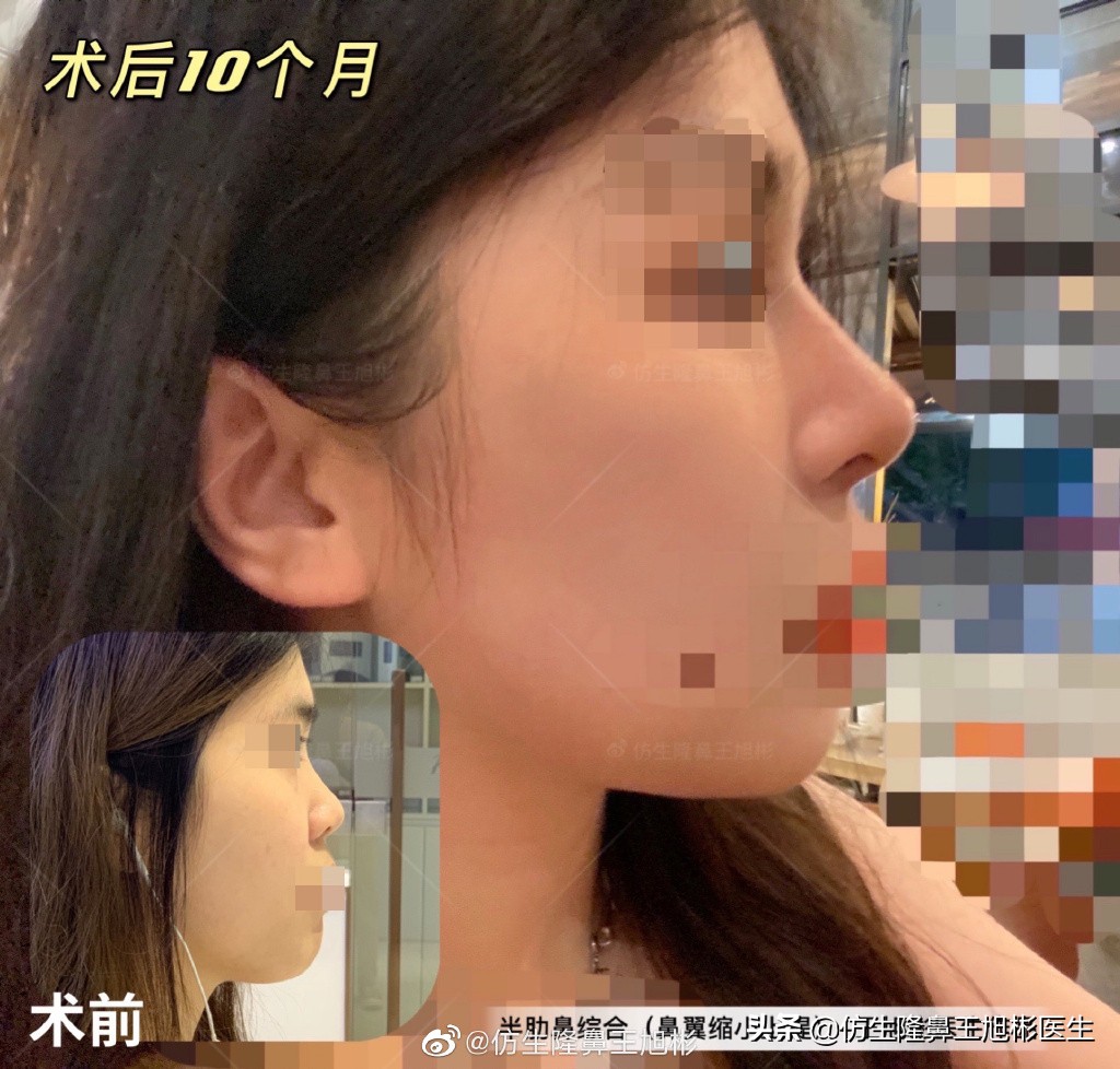 那些被鼻子“封印”颜值的鼻综合/修复案例|广州鼻整形