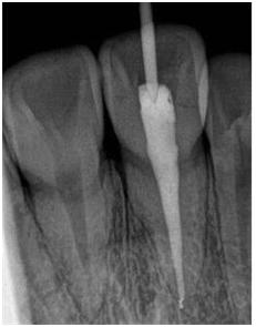 你们做根管治疗花了多少钱,根管治疗做了真的有用吗