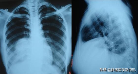 癌症组织学分级3级严重不,癌症组织学分级意义
