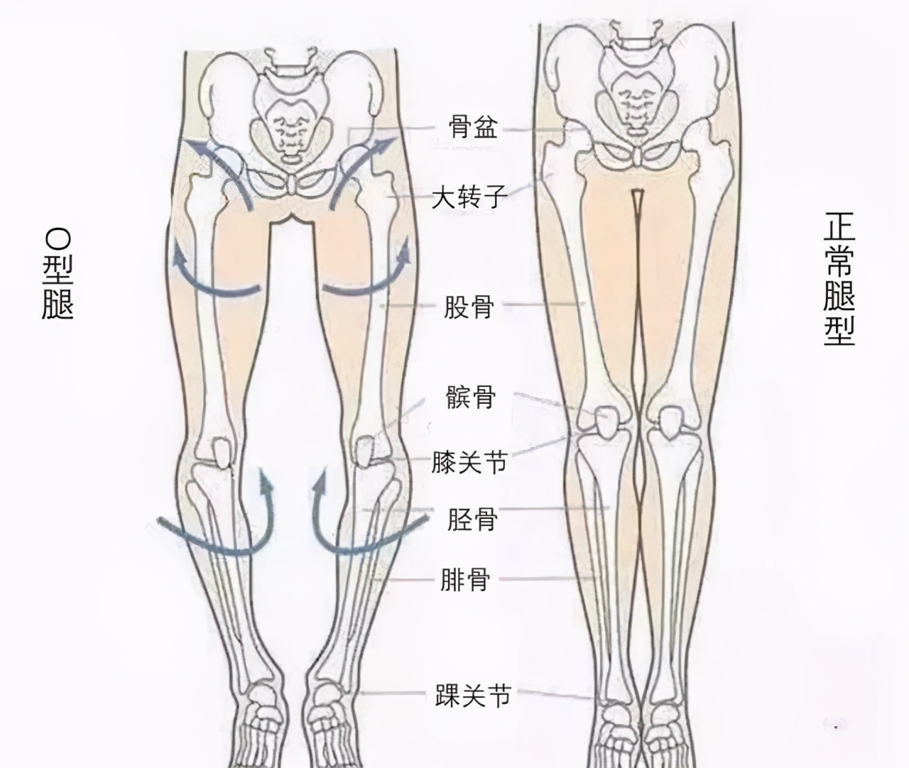x腿型矫正十种让腿变直的方法,腿不直怎么矫正腿型