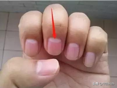指甲上没月牙有横线长倒刺,关于指甲的科普指甲上的疾病视频