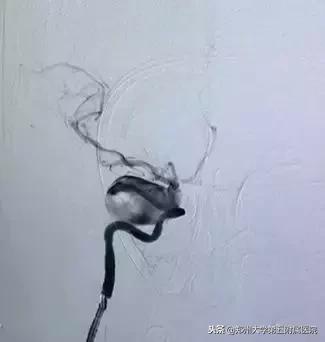 脑动脉瘤介入手术病例,天坛医院神经介入治疗颅内动脉瘤