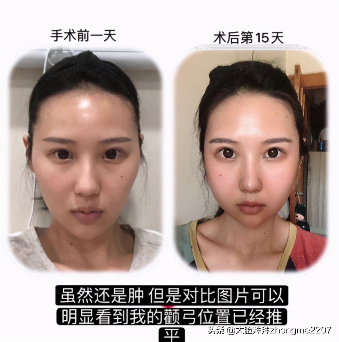 颧骨颧弓内推手术全过程真人,颧骨内推颧弓手术恢复全过程分享