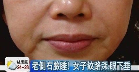 美颜都遮不住的法令纹该怎么回答,滤镜才是法令纹的天敌