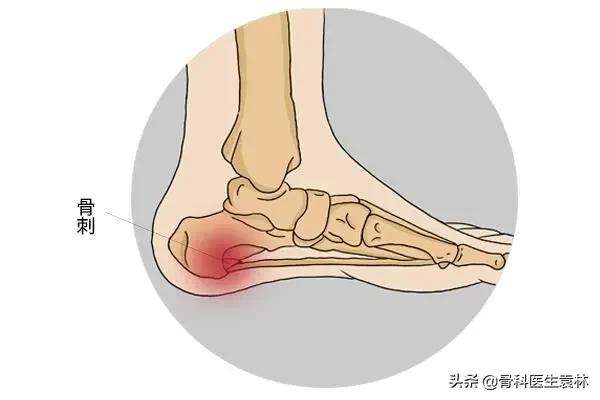 骨质增生到底是怎么回事呢？老人膝关节骨质增生还能治好吗？