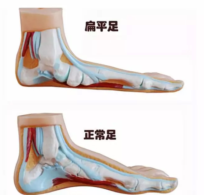 扁平足的危害一岁宝宝,现在的小孩好多的是扁平足