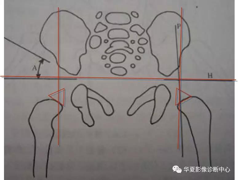 先天性髋关节脱位,先天性髋关节脱位属不属于残疾人