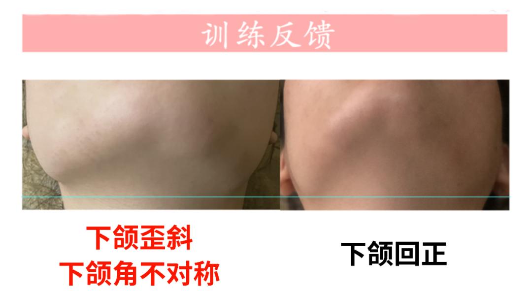 下颌偏歪会引起哪边脸大,下颌紊乱跟大小脸有关系