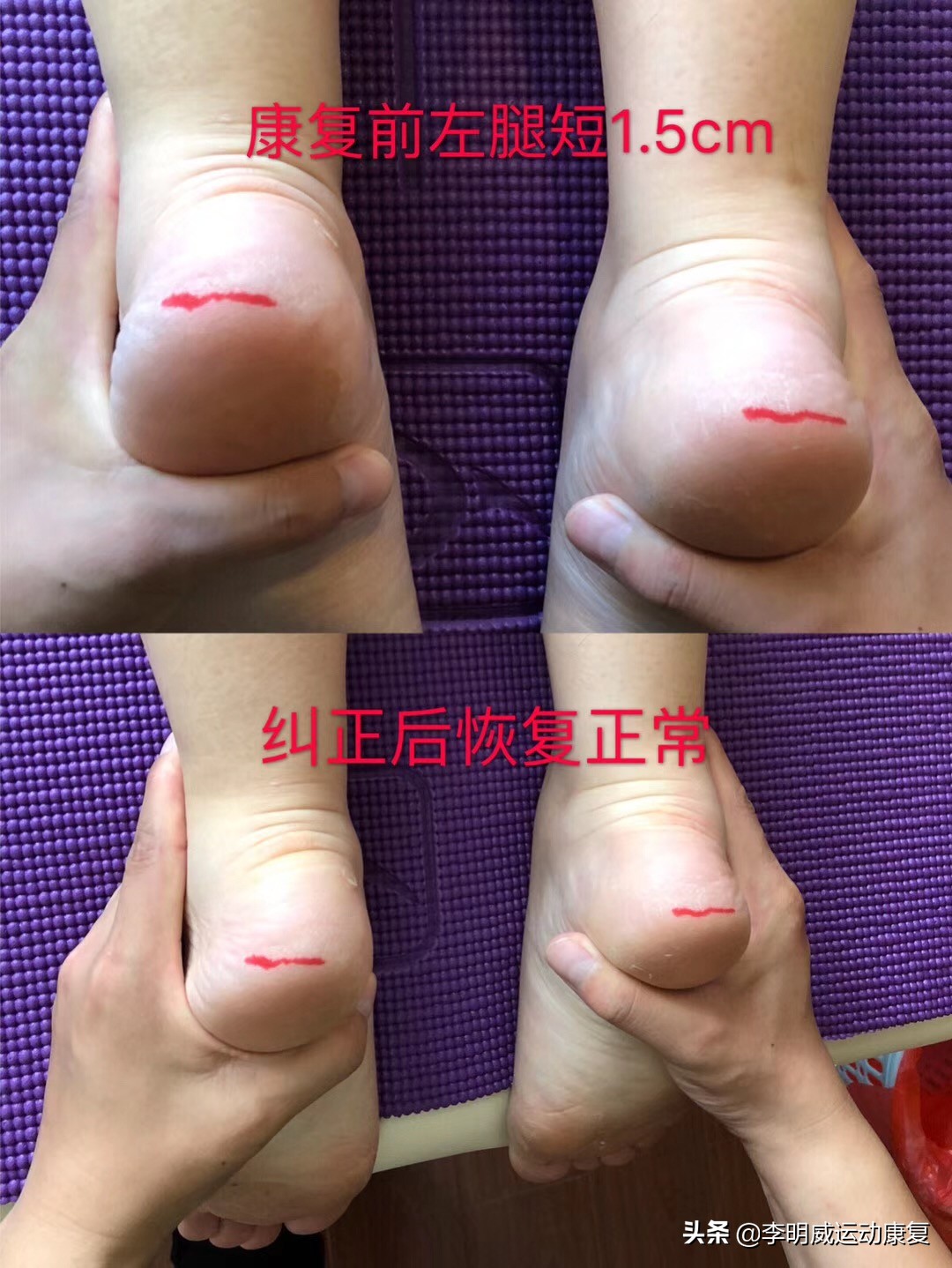 骨盆不正导致腿不直,骨盆不正导致的长短腿症状